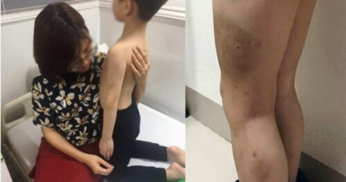 vụ việc bé lớp 1 bị bạo hành đã được phát hiện khi cô giáo thấy trên người bé có hàng chục vết bầm tím như chân, đùi, tay, mông và cả lưng